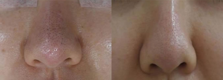carbon-laser-peel-santa-barbara-before-and-after-1-a4d340a9